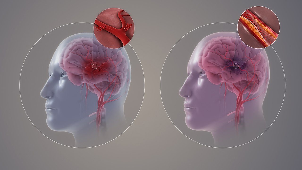 https://e-neurologos.gr/aggeiako-egkefaliko-epeisodio/
